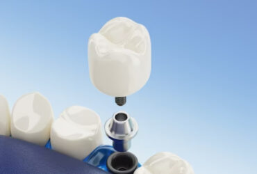 Dental Crown & Bridge