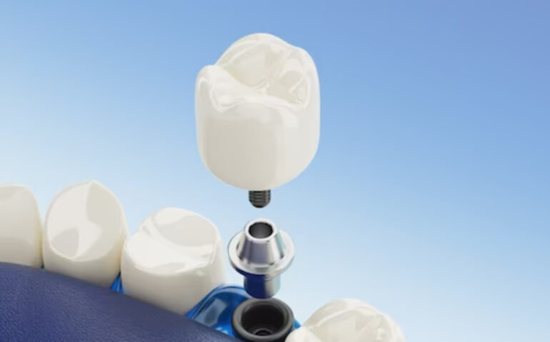 Bridges-and-Dental-Crowns-Treatment-in-Gandhinagar