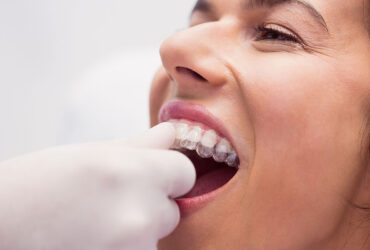 Clear Aligners Invisalign