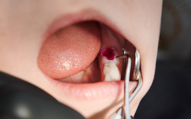 Dental-Cavities-Treatment-in-Gandhinagar