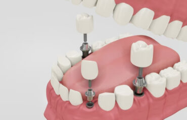 Dental Implants