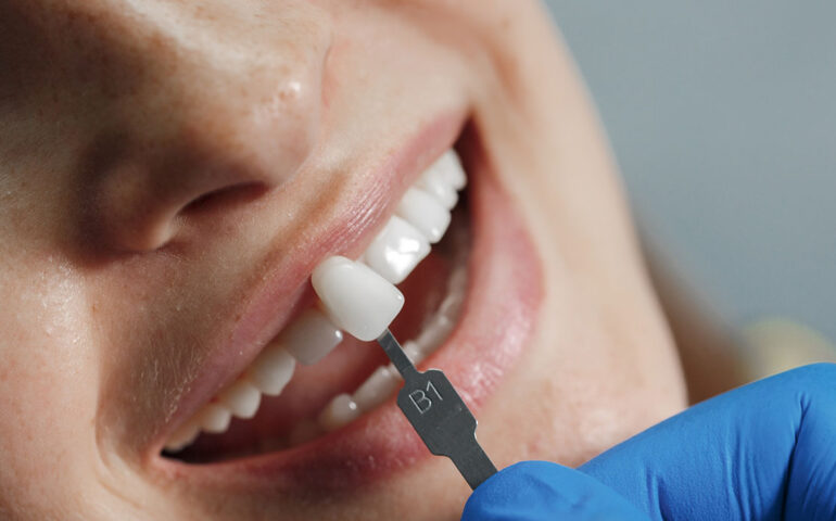 Dental-Veneers-in-Gandhinagar