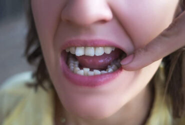 Misaligned Teeth Treatment