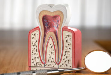 Root Canal Treatment (RCT)