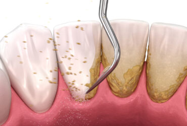 Teeth Scaling, Deep Cleaning, Root Planning