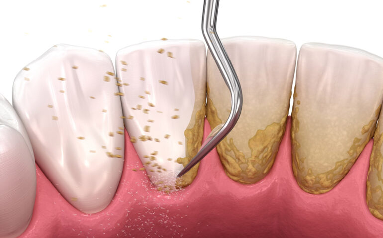 Teeth Scaling Ahmedabad