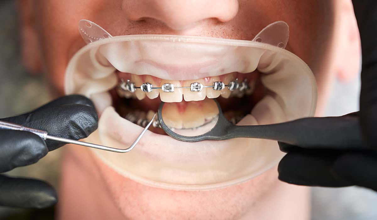 Dental Braces Treatment and Why it is important???