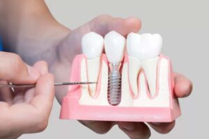 Having fear of dental implants?