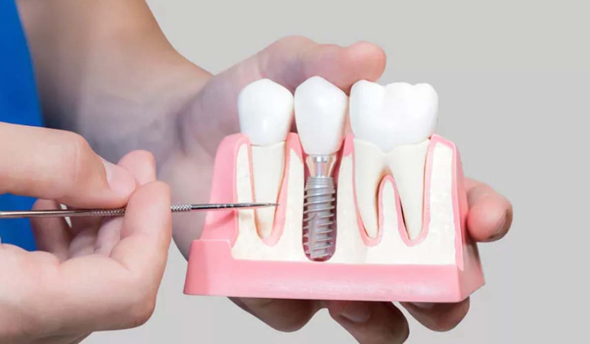 Having fear of dental implants?