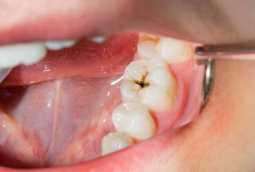 Dental Cavity & Tooth Decay Treatment