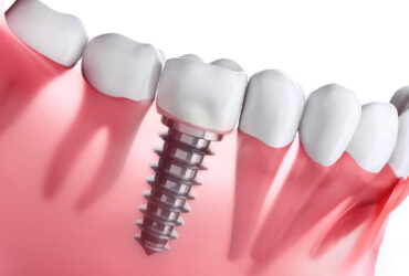 Dental Implants