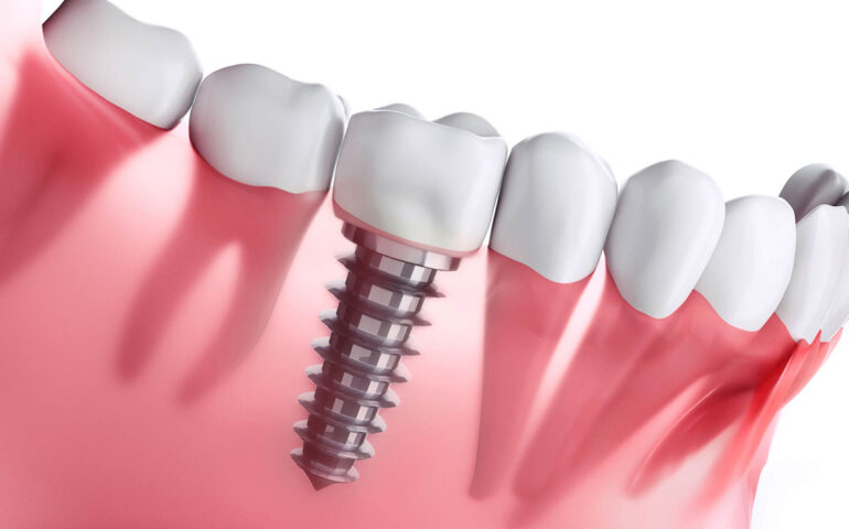Dental Implants