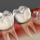 Does Wisdom Tooth Cause Cancer?
