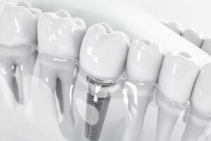 The Revolutionary Solution : Dental Implants