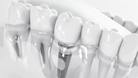 The Revolutionary Solution : Dental Implants