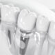 The Revolutionary Solution : Dental Implants
