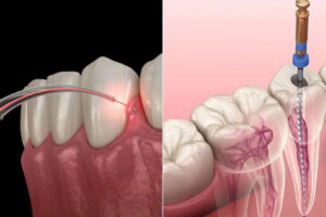 Difference Between Laser and Traditional Root Canal Treatment