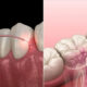 Difference Between Laser and Traditional Root Canal Treatment