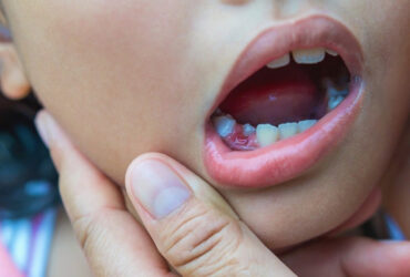 Child Root Canal