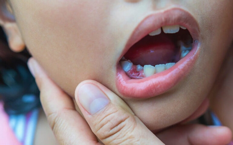 Child Root Canal