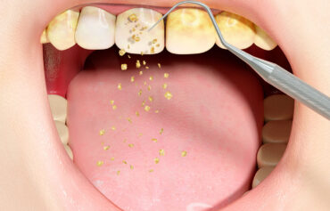 Deep Cleaning and Curettage