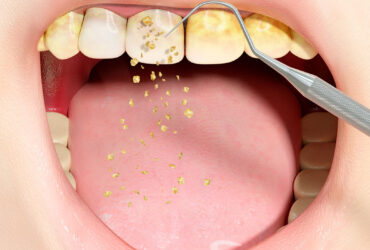 Deep Cleaning and Curettage