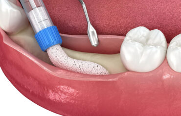 Dental Alveoloplasty