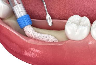 Dental Alveoloplasty