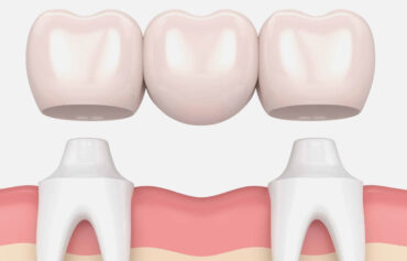 Dental Bridges