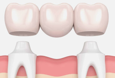 Dental Bridges
