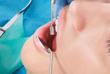 Dental Conservative Treatment