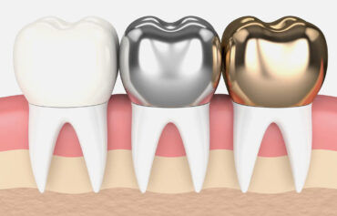 Dental Crowns