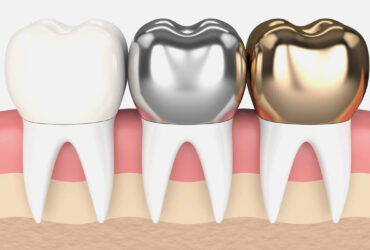 Dental Crowns