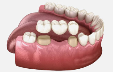 Dental Crowns, Bridges, and Veneers