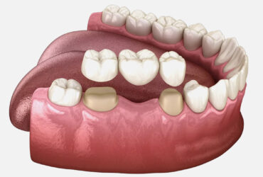 Dental Crowns, Bridges, and Veneers