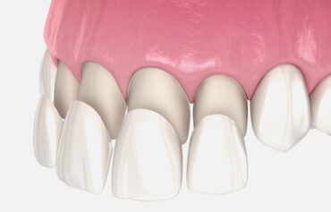 Dental Venners