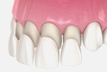 Dental Venners