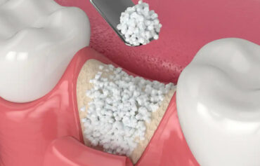 Flap Surgery and Bone Grafting