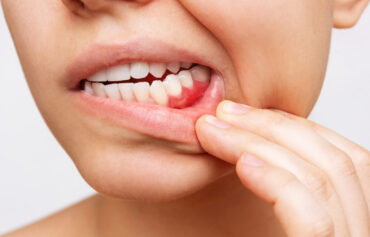 Gum Diseases