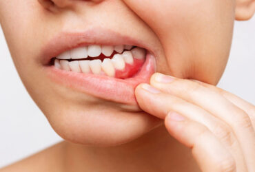 Gum Diseases