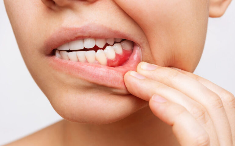 Gum Diseases