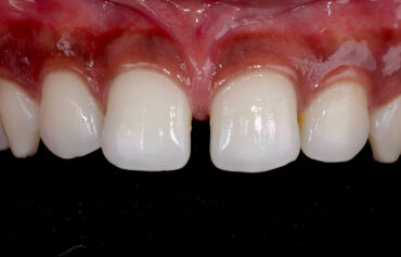 Midline Diastema Closure