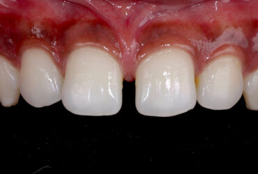 Midline Diastema Closure