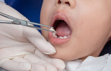 Milk Tooth Extraction
