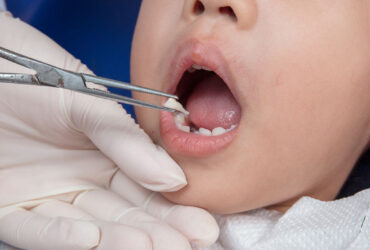 Milk Tooth Extraction