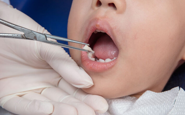 Milk Tooth Extraction