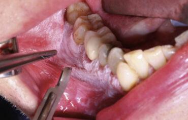 Oral Biopsy
