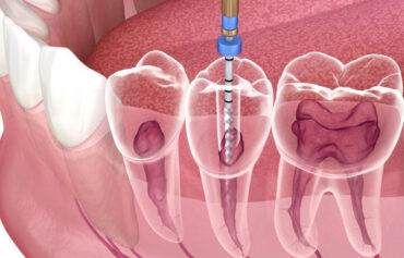 Root Canal Treatment