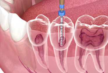 Root Canal Treatment