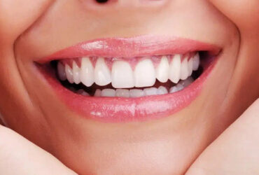 Smile Analysis and Smile Design